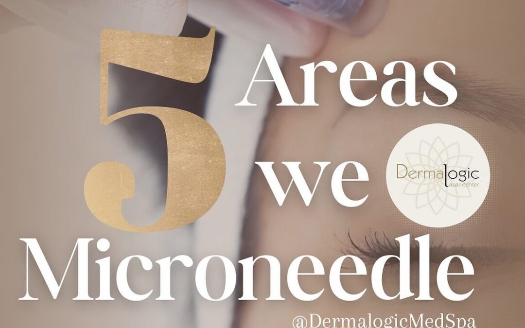 Microneedling Magic: 5 Key Areas for Total Skin Transformation