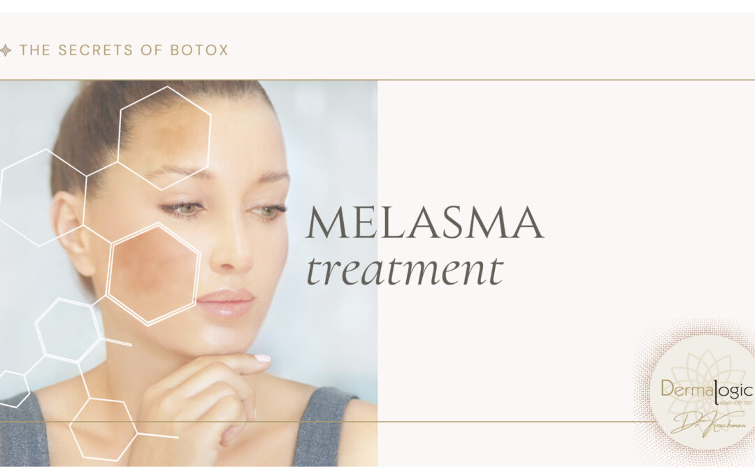 Melasma: Causes and Comprehensive Treatment Options at Dermalogic